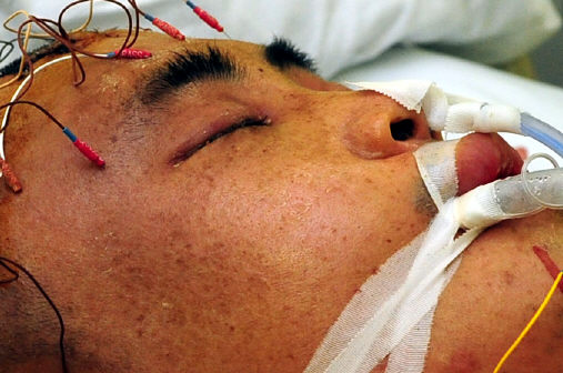<b>이별 아는듯…‘젖은 눈가’</b>  최요삼이 2일 서울아산병원에서 뇌사판정 절차로 뇌파검사를 받고 있다. 검사를 받는 동안 최요삼의 눈가에 물이 고여 있다. 지인들은 “요삼이가 이렇게 가는 것이 아쉬워 눈물을 흘리는 것 같다”고 했다. 연합뉴스