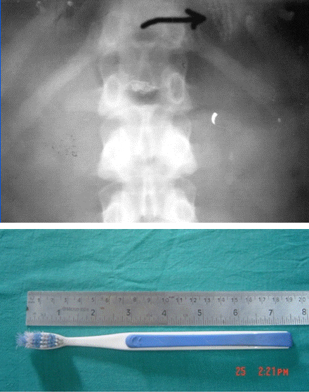 위사진 화살표 : 위 안의 칫솔, 아래 사진 : 꺼낸 칫솔. 출처:Internet journal of H&N surgery / 한겨레 블로그 한정호