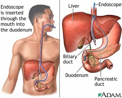 간략한 ERCP 도해 / 한겨레 블로그 한정호