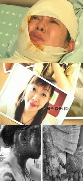 피해자 박정아씨의 현 모습,  과거모습,씻을 수 없는 상처들