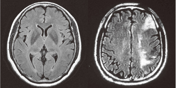 엠아르아이(MRI·자기공명영상촬영) 검사로 본 정상 뇌(왼쪽)와 뇌졸중에 걸린 뇌의 모습(오른쪽).  
 서울대병원  제공