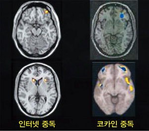 인터넷 중독 뇌 사진