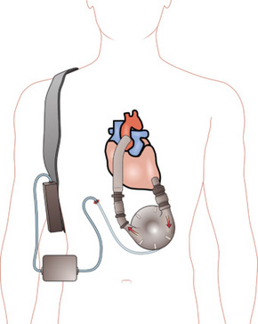 독고진이 단 것으로 나오는 인공심장 혹은 심장보조장치 LVAD. 위키피디아 사진.