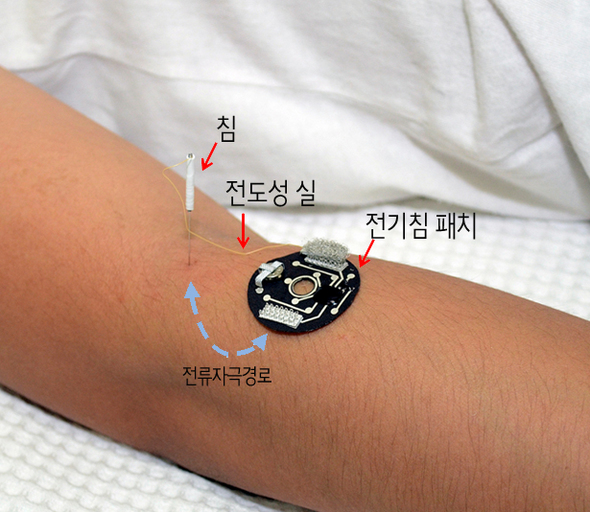 ‘스마트 전기침 시스템’은 전기침 패치, 침, 전도성 실로 구성된다. 사진 제공 : KAIST