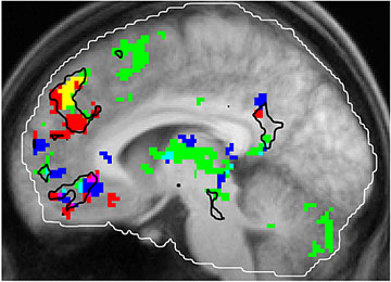 음악을 듣는 사람의 뇌를 찍은 기능성자기공명영상(fMRI). 녹색은 귀에 익은 음악을 들을 때 반응하는 부분. 빨간색은 결정적 기억과 관련된 부분. 파란색은 음악이 즐겁게 인식될 때 활성화된 부분. 노란색은 이마 바로 뒤에 있는 위쪽 전전두엽의 안쪽 부분으로 귀에 익은 음악과 결정적 기억 모두에 반응하는 부분.  자료 출처: 미국 캘리포니아 대학교 데이비스 캠퍼스 홈페이지
　
