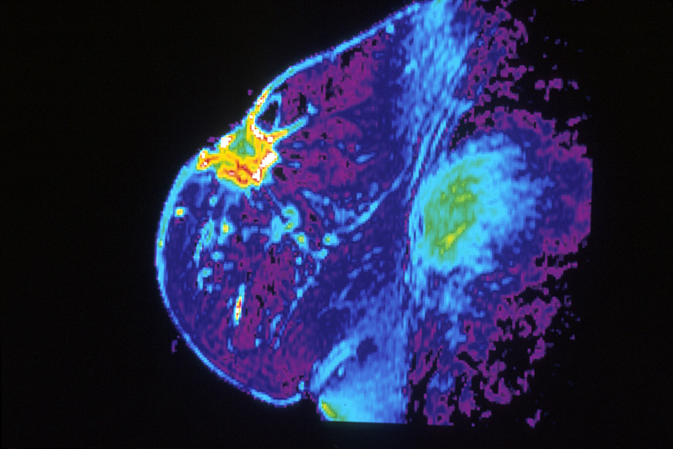 유방암이 걸린 환자의 MRI 사진. Wikimedia