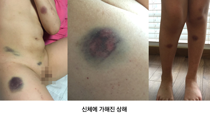 자폐 초등생 부모가 아들의 폭행 상처라며 공개한 사진.