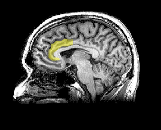 왕따, 이지메 등 사회적 격리를 당하면 활성화 되는 전두엽 전대상피질(anterior cingulate cortex). 이 부위는 사람이 신체적 고통을 느낄 때 역시 활성화 되는 곳이다. 위키피디아