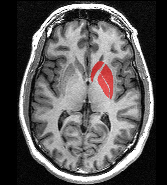 뇌 줄무늬체(striatum 빨강 부분) 이미지 출처. 위키피디아