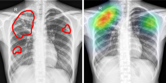 미국 국립보건원(NIH)가 공개한 결핵 영상(500번)에 인간 의사(왼쪽)와 인공지능이 병변의 위치를 표시했다. 인공지능은 딥러닝으로 병변의 위치를 파악해 히트맵 이미지로 표시했다. 출처 : NIH, 루닛