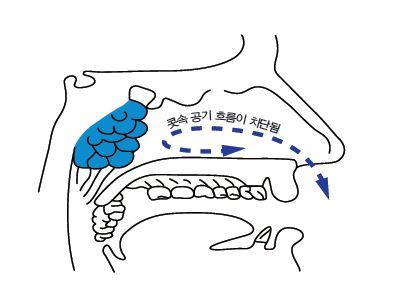 목구멍의 편도나 아데노이드가 비정상적으로 큰 경우 콧속 공기 흐름이 차단돼 코골이나 수면무호흡증이 생긴다. <코골이 수면무호흡증, 양압기로 치료한다>에서 발췌.