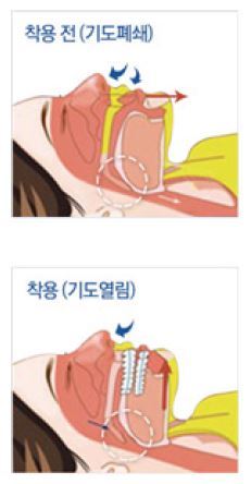 틀니처럼 생긴 구강내장치를 착용했을 때 목구멍의 공기 통로가 넓어지는 모습. <코골이 수면무호흡증, 양압기로 치료한다>에서 발췌.