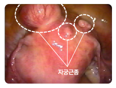 복강경으로 관찰한 결과 자궁의 겉에도 자궁근종이 보인다. 제일병원 제공