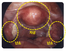 복강경으로 관찰한 정상 자궁과 난소의 모습. 제일병원 제공