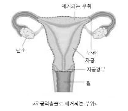 자궁출혈이나 골반통 등 자궁근종의 증상이 있는 경우 등에서 더 이상 임신이 필요하지 않으면 자궁적출술을 한다. 이때 자궁경부를 남기기도 한다. 서울아산병원 제공