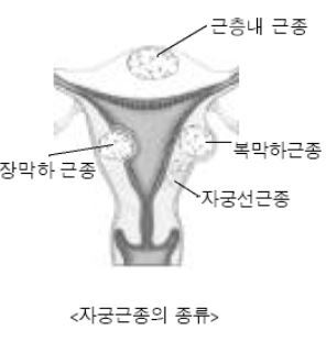 자궁근종이 생기는 위치에 따라 자궁근종의 종류가 달라진다. 서울아산병원 제공