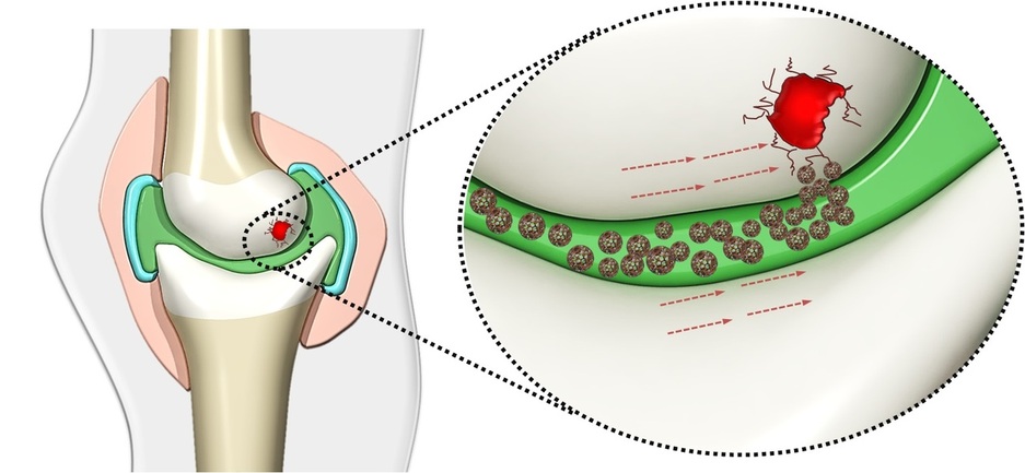 관절연골 줄기세포를 실은 마이크로로봇이 관절염 부위에 작용하는 과정을 묘사한 그림. 전남대 마이크로로봇의료로봇센터 제공.