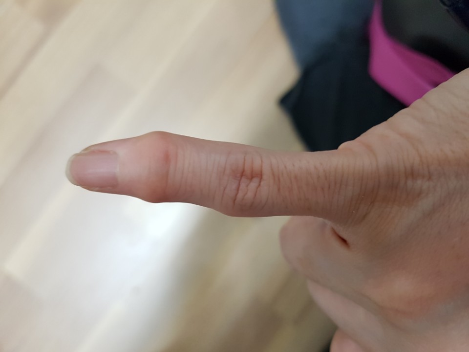 계속된 학교 급식 노동으로 변형이 생긴 손가락 관절 모습. 전국학교비정규직노조 강원지부