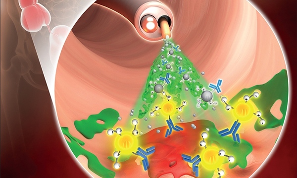 대장암 찾는 스프레이·면역세포 강화 나노입자 개발