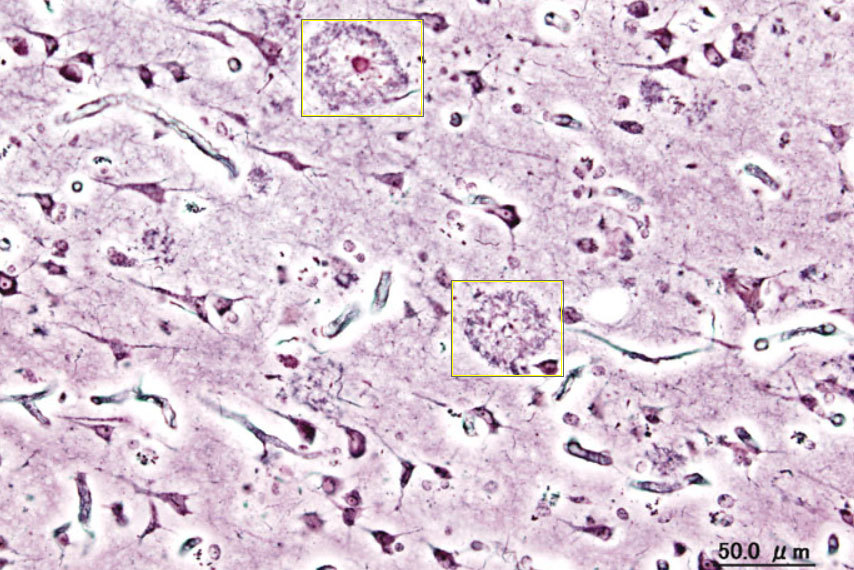 알츠하이머 환자의 신피질. 원인 단백질의 응집으로 생긴 노인성 반점들이 관찰된다(네모 안). 출처: 위키미디어 코먼스