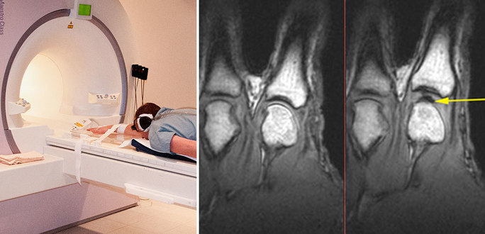 손가락을 잡아당겨 관절에서 소리가 날 때의 관절을 자기공명영상으로 촬영하는 모습. 오른쪽은 손가락 관절을 잡아당기기 전과 후의 영상. 화살표는 관절을 잡아당길 때 관절에 생긴 빈 공간을 가리킨다. 캐나다 앨버타대학 제공