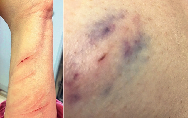 애견미용사들이 미용을 하다가 개에 물려도 견주나 숍 주인, 수의사 등에게 정당한 보상을 받지 못하고 있다. 애견미용사 인권 운동 ME TOO 모임 제공