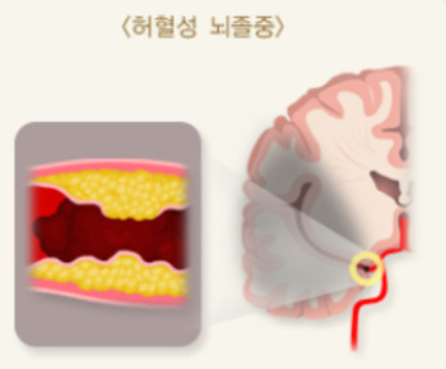 허혈성 뇌졸중은 피가 굳어 생기는 혈전이 뇌혈관을 막아 생긴다. 치료는 이 혈전을 녹여 혈액 순환이 다시 이뤄지도록 하는 것인데, 이에 대한 건강보험 적용이 8월부터 확대된다. <한겨레> 자료사진