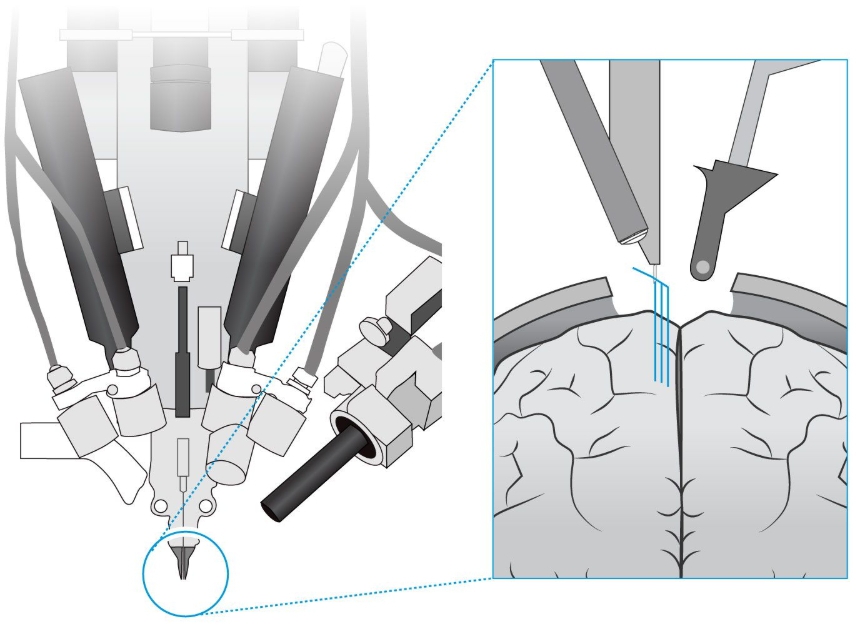 외과 수술을 통해 쥐의 두개골을 열고 ‘재봉틀 로봇‘을 이용해 뇌에 미세한 폴리머 전극을 삽입했다. 출처 뉴럴링크(Neuralink; “The ‘Sewing Machine’ for Minimally Invasive Neural Recording”, Hanson et al.)