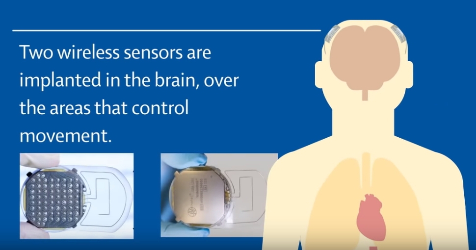 프랑스 그르노블대 연구진은 티보의 뇌에서  사지의 동작을 관할하는 부위의 두개골을 열어 64개의 전극이 있는 임플란트를 심었다. 이후 무선장치를 통해 뇌파를 해석하는 알고리즘을 만들어 외골격장치의 동작과 연계시켰다.  랜싯 제공.