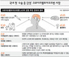 뇌막 이식환자서 ‘유사 광우병’…추가 발병 우려