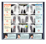 ‘닥터 인공지능’, 의사가 놓친 결핵을 찾아내다