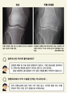 “운동도 열심히 하고 날씬한 제가 무릎 관절염이라뇨?”