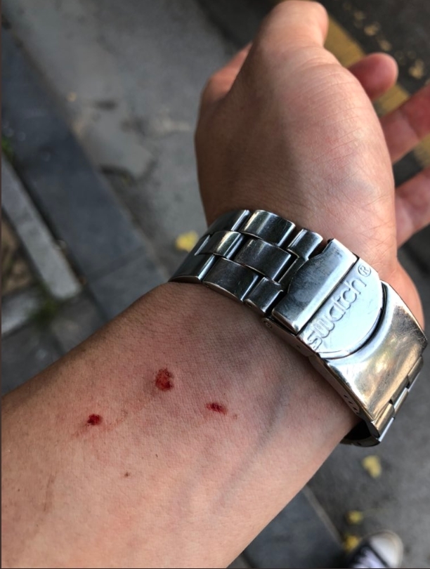 제1회인천퀴어문화축제에 참가했다가 팔에 상처를 입었다며 한 축제 참가자가 트위터에 올린 사진.