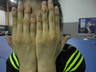 Fingers swollen from intense practice